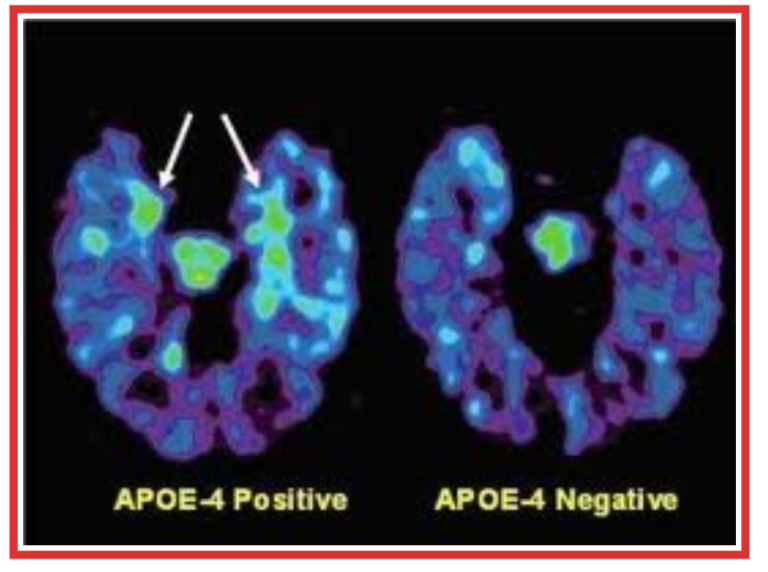 L'Alzheimer e il gene APOE